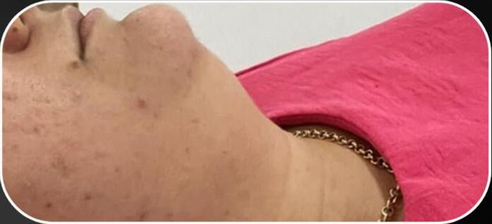 Antes — LINHA MANDIBULAR E PESCOÇO · APÓS 1 SESSÃO