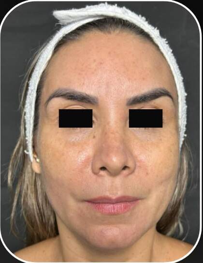 Depois — FACE · APÓS 1 SESSÃO