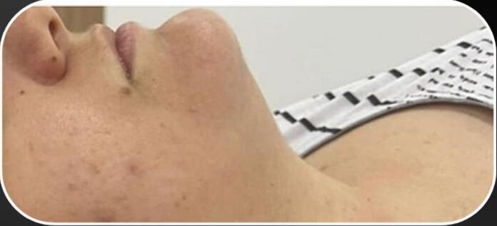 Depois — LINHA MANDIBULAR E PESCOÇO · APÓS 1 SESSÃO