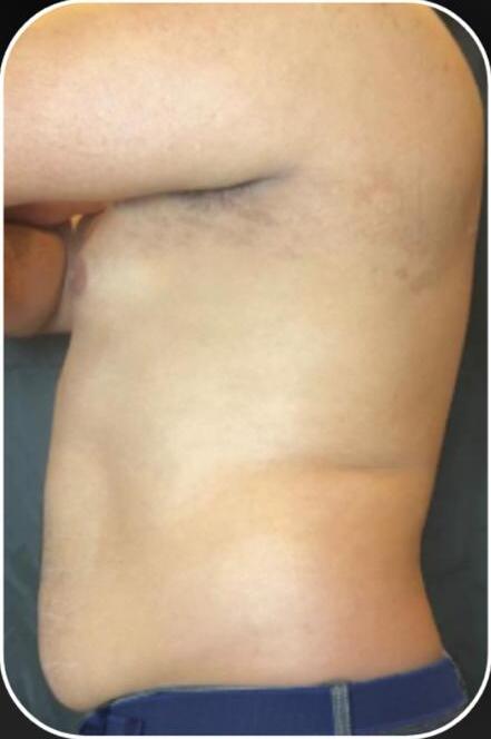 Depois — REGIÃO CORPORAL · APÓS 1 SESSÃO