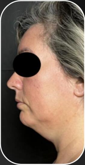 Antes — CONTORNO FACIAL E PAPADA